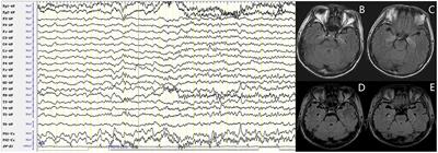 Clinical and Electroencephalographic Features of the Seizures in Neuronal Surface Antibody-Associated Autoimmune Encephalitis